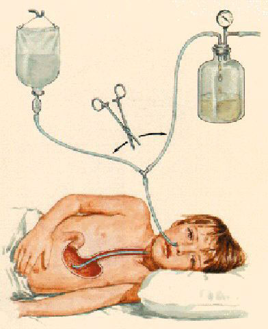 Soluzione, 1997