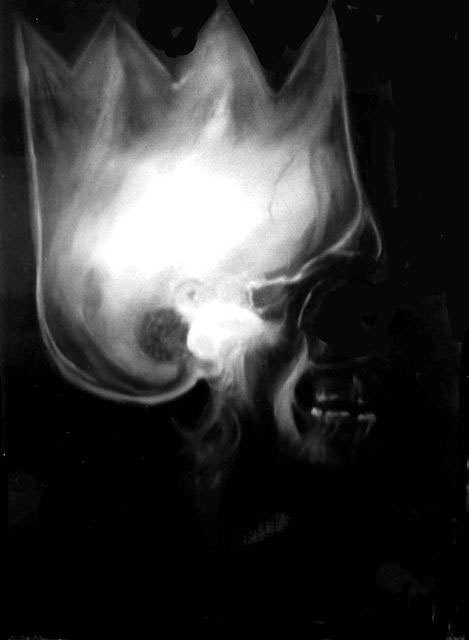 Radiografia di Burt Simpson, 1992